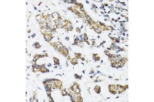 Immunohistochemistry of paraffin-embedded human breast cancer using DHRS2 antibody (ABIN5973846) at dilution of 1/100 (40x lens). (DHRS2 antibody)