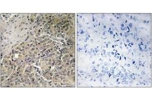 Immunohistochemistry analysis of paraffin-embedded human prostate carcinoma, using A26C2/3 Antibody. (A26C2/3 (AA 401-450) antibody)