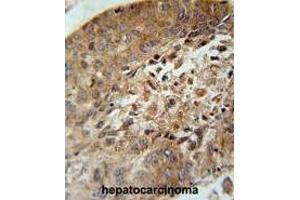 ACD10 Antibody (Center) immunohistochemistry analysis in formalin fixed and paraffin embedded human hepatocarcinoma followed by peroxidase conjugation of the secondary antibody and DAB staining. (ACAD10 antibody  (Middle Region))