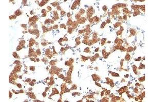 Formalin-fixed, paraffin-embedded human thyroid carcinoma stained with Keratin 18 antibody (C-04).