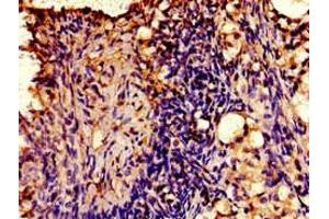 Immunohistochemistry of paraffin-embedded human ovarian cancer using ABIN7175412 at dilution of 1:100