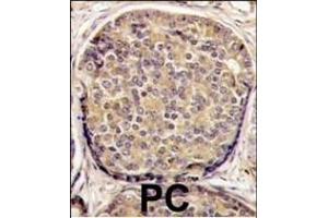 Formalin-fixed and paraffin-embedded human prostata carcinoma tissue reacted with PI3KCB antibody (C-term), which was peroxidase-conjugated to the secondary antibody, followed by DAB staining. (PI3KCB (AA 713-744), (C-Term) antibody)
