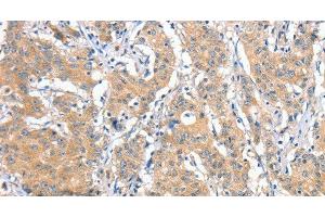 Immunohistochemistry of paraffin-embedded Human gastric cancer tissue using ANKMY2 Polyclonal Antibody at dilution 1:30 (ANKMY2 antibody)