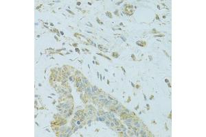 Immunohistochemistry of paraffin-embedded human breast cancer using MTFP1 antibody (ABIN5975088) at dilution of 1/100 (40x lens). (Mtfp1 antibody)