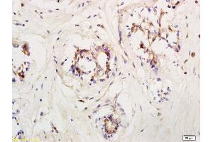 Formalin-fixed and paraffin embedded human breast carcinoma labeled with Anti LIFR/CD118 Polyclonal Antibody, Unconjugated (ABIN686827) at 1:200 followed by conjugation to the secondary antibody and DAB staining (LIFR antibody  (AA 451-580))