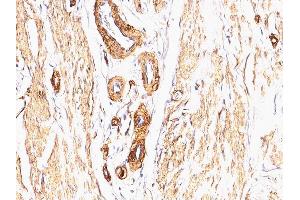 Formalin-fixed, paraffin-embedded human Leiomyosarcoma stained with Smooth Muscle Actin Mouse Monoclonal Antibody (SPM332). (Smooth Muscle Actin antibody  (N-Term))