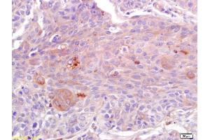 Formalin-fixed and paraffin embedded human lung carcinoma labeled with Anti-ADAMTS4 Polyclonal Antibody, Unconjugated (ABIN755173) at 1:200 followed by conjugation to the secondary antibody and DAB staining. (ADAMTS4 antibody  (AA 501-839))