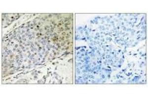 Immunohistochemistry analysis of paraffin-embedded human breast carcinoma tissue, using RMP antibody. (URI1 antibody  (C-Term))