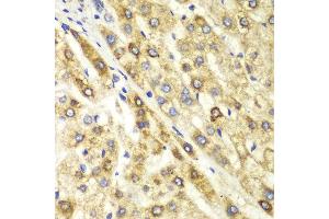 Immunohistochemistry of paraffin-embedded human liver cancer using CTBP1 antibody at dilution of 1:100 (400x lens). (CTBP1 antibody)