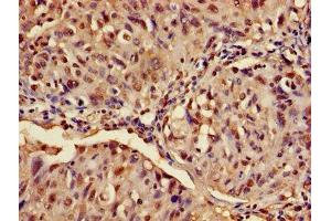 Immunohistochemistry of paraffin-embedded human lung cancer using ABIN7144793 at dilution of 1:100 (Ataxin 3 antibody  (AA 1-288))