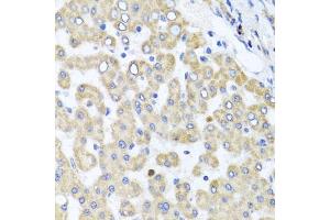 Immunohistochemistry of paraffin-embedded human liver injury using RAB24 antibody (ABIN5974578) at dilution of 1/100 (40x lens). (RAB24 antibody)