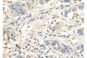 ABIN6260576 and ABIN6276962 at 1/100 staining Human gastric cancer by IHC-P.