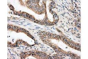 Immunohistochemical staining of paraffin-embedded Carcinoma of liver tissue using anti-BTK mouse monoclonal antibody. (BTK antibody)