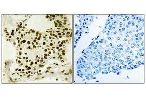 Immunohistochemistry analysis of paraffin-embedded human breast carcinoma tissue using UBF (Phospho-Ser484) antibody. (UBTF antibody  (pSer484))