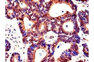 Immunohistochemistry of paraffin-embedded human colon cancer using ABIN7143200 at dilution of 1:100 (ACSF2 antibody  (AA 42-615))