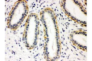 Anti- SLC6A4 Picoband antibody, IHC(P) IHC(P): Human Mammary Cancer Tissue (SLC6A4 antibody  (N-Term))