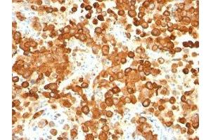 Formalin-fixed, paraffin-embedded human melanoma stained with gp100 antibody (HMB45 + PMEL/783).