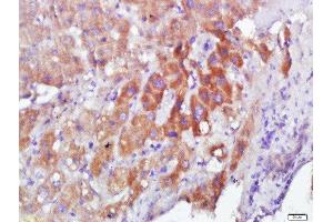 Paraformaldehyde-fixed, paraffin embedded human hepatocelluar carcinoma, Antigen retrieval by boiling in sodium citrate buffer (pH6) for 15min, Block endogenous peroxidase by 3% hydrogen peroxide for 30 minutes, Blocking buffer (normal goat serum) at 37°C for 20min, Antibody incubation with Calmodulin Polyclonal Antibody, Unconjugated  at 1:200 overnight at 4°C, followed by a conjugated secondary and DAB staining. (Calmodulin 1 antibody  (AA 81-152))