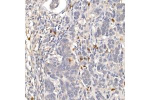 Immunohistochemistry of paraffin-embedded human colon carcinoma using NUR77 Rabbit pAb (ABIN6132395, ABIN6144826, ABIN6144829 and ABIN6222380) at dilution of 1:100 (40x lens). (NR4A1 antibody  (AA 1-170))