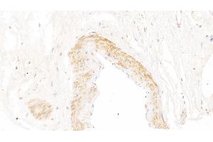 Detection of SCGB2A2 in Human Breast cancer Tissue using Polyclonal Antibody to Secretoglobin Family 2A, Member 2 (SCGB2A2) (Mammaglobin A antibody  (AA 19-93))