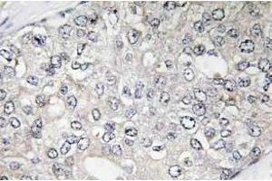 Immunohistochemistry (IHC) analyzes of p-p70 S6 kinase alpha antibody in paraffin-embedded human breast carcinoma tissue. (RPS6KB1 antibody  (pThr444))