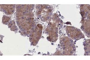 ABIN6272763 at 1/100 staining Human liver cancer tissue by IHC-P. (OR52N5 antibody  (C-Term))