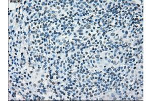 Immunohistochemical staining of paraffin-embedded Adenocarcinoma of colon tissue using anti-PRKYmouse monoclonal antibody. (PRKY antibody)