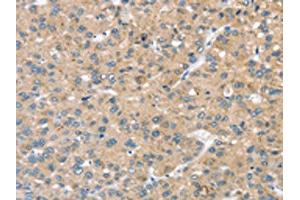 The image on the left is immunohistochemistry of paraffin-embedded Human liver cancer tissue using ABIN7192685(STK32C Antibody) at dilution 1/20, on the right is treated with synthetic peptide.