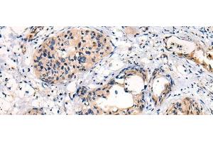 Immunohistochemistry of paraffin-embedded Human cervical cancer tissue using C16orf45 Polyclonal Antibody at dilution of 1:45(x200) (C16orf45 antibody)