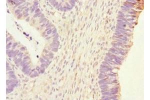 Immunohistochemistry of paraffin-embedded human ovarian cancer using ABIN7163403 at dilution of 1:100 (PHKG2 antibody  (AA 237-406))