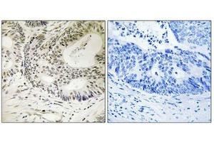 Immunohistochemistry analysis of paraffin-embedded human colon carcinoma tissue using 53BP1 (Phospho-Ser25) antibody.