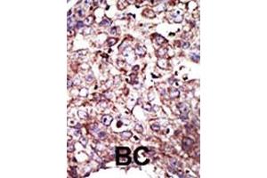 Formalin-fixed and paraffin-embedded human cancer tissue reacted with the primary antibody, which was peroxidase-conjugated to the secondary antibody, followed by DAB staining. (FNTA antibody  (C-Term))