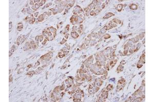 IHC-P Image Immunohistochemical analysis of paraffin-embedded human breast cancer, using NDUFA10, antibody at 1:250 dilution. (NDUFA10 antibody  (Center))
