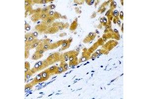 Immunohistochemical analysis of GPD2 staining in human liver cancer formalin fixed paraffin embedded tissue section. (GPD2 antibody)