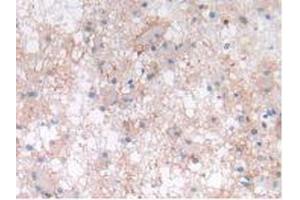 IHC-P analysis of Human Glioma Tissue, with DAB staining. (LIF antibody  (AA 2-201))