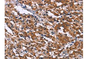 The image on the left is immunohistochemistry of paraffin-embedded Human thyroid cancer tissue using ABIN7192381(SKI Antibody) at dilution 1/40, on the right is treated with synthetic peptide. (SKI antibody)