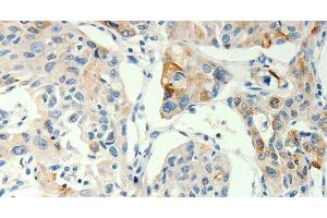 Immunohistochemistry of paraffin-embedded Human lung cancer tissue using TRPA1 Polyclonal Antibody at dilution 1:60 (TRPA1 antibody)