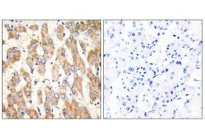 Immunohistochemistry analysis of paraffin-embedded human liver carcinoma tissue, using BAX antibody. (BAX antibody  (Internal Region))