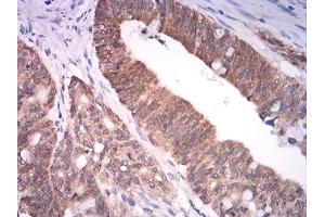 Immunohistochemical analysis of paraffin-embedded rectum cancer tissues using ASH2L mouse mAb with DAB staining. (ASH2L antibody  (AA 493-628))