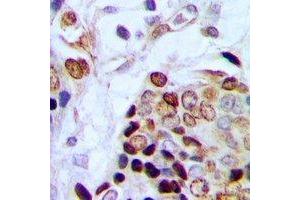 Immunohistochemical analysis of TAF15 staining in human prostate cancer formalin fixed paraffin embedded tissue section. (TAF15 antibody)