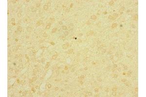 Immunohistochemistry of paraffin-embedded human glioma using ABIN7158206 at dilution of 1:100 (Lrig1 antibody  (AA 35-220))