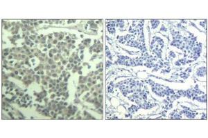 Immunohistochemical analysis of paraffin-embedded human breast carcinoma tissue using c-kit(Phospho-Tyr936) Antibody(left) or the same antibody preincubated with blocking peptide(right). (KIT antibody  (pTyr936))
