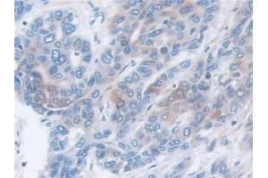 Detection of MMP3 in Human Liver cancer Tissue using Monoclonal Antibody to Matrix Metalloproteinase 3 (MMP3) (MMP3 antibody  (AA 363-477))