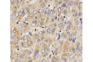 Immunohistochemistry of paraffin-embedded Human liver cancer using Eif2ak2 Polyclonal Antibody at dilution of 1:200 (40x lens). (EIF2AK2 antibody)