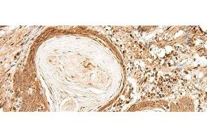 Immunohistochemistry of paraffin-embedded Human esophagus cancer tissue using FIZ1 Polyclonal Antibody at dilution of 1:35(x200) (FIZ1 antibody)