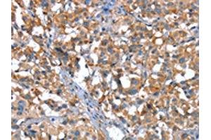 The image on the left is immunohistochemistry of paraffin-embedded Human thyroid cancer tissue using ABIN7190040(CACNA1G Antibody) at dilution 1/20, on the right is treated with synthetic peptide. (CACNA1G antibody)