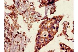 Immunohistochemistry of paraffin-embedded human pancreatic cancer using ABIN7174362 at dilution of 1:100 (CYLD antibody  (C-Term))