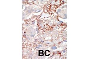 Formalin-fixed and paraffin-embedded human cancer tissue reacted with the primary antibody, which was peroxidase-conjugated to the secondary antibody, followed by AEC staining. (STK3 antibody  (C-Term))