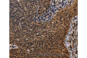 Immunohistochemistry of Human colon cancer using FHL3 Polyclonal Antibody at dilution of 1:40