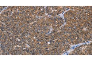 Immunohistochemistry of paraffin-embedded Human ovarian cancer using FABP6 Polyclonal Antibody at dilution of 1:30 (FABP6 antibody)